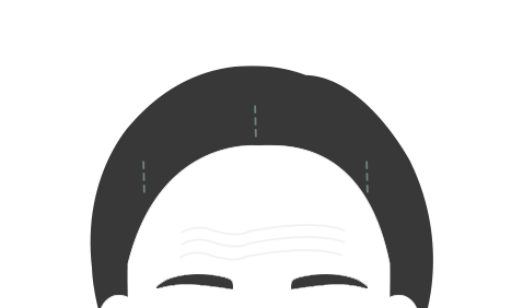 지방이식 STEP 01